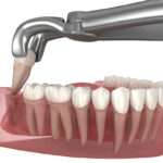 wisdom teeth surgery