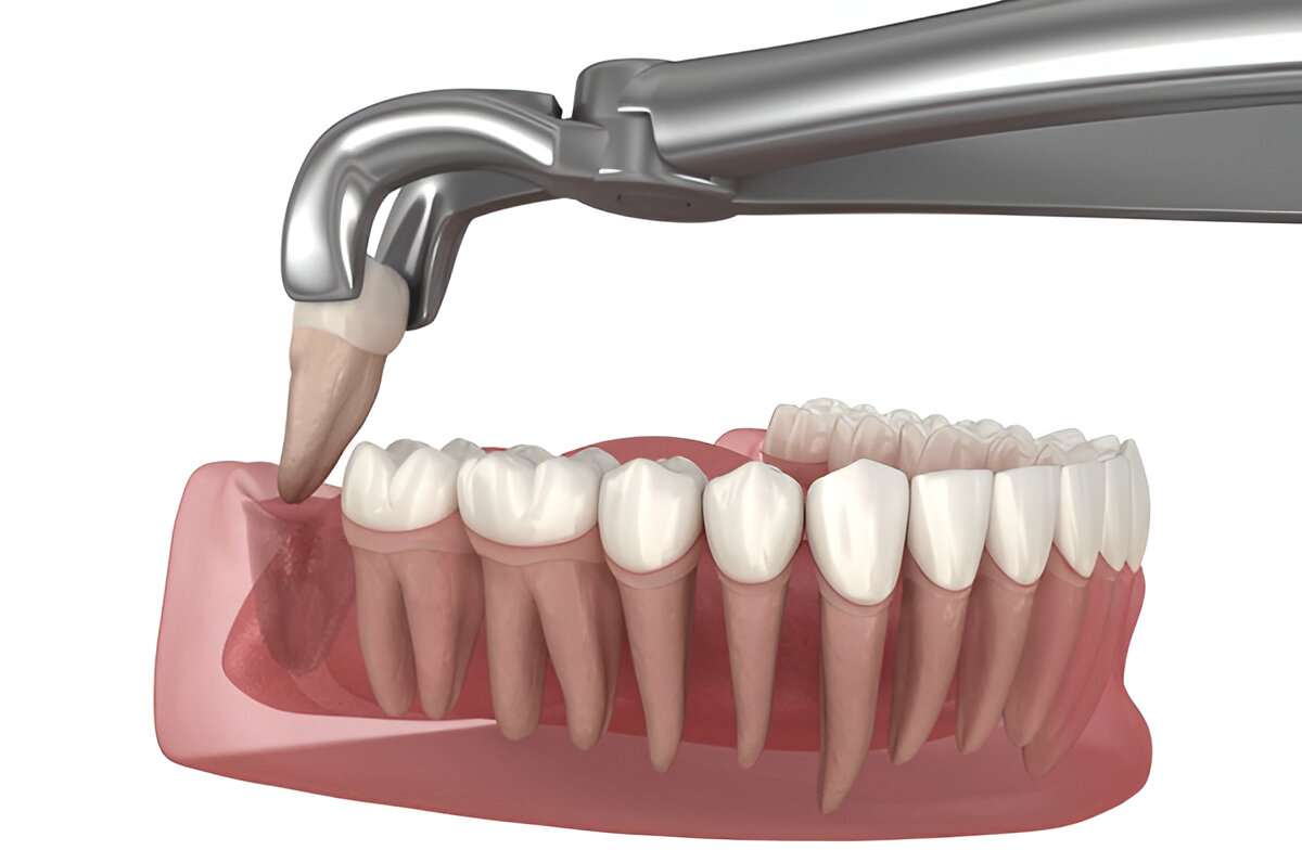 wisdom teeth surgery
