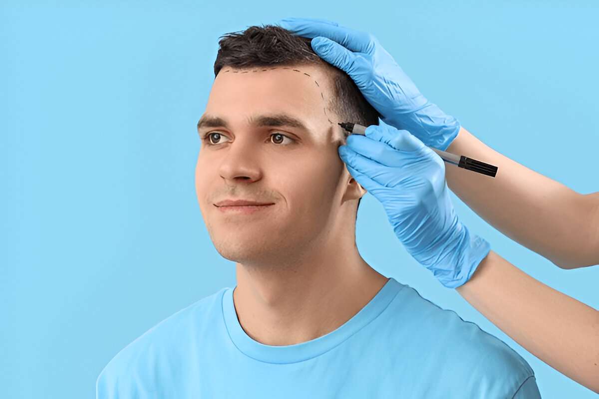 Hair Transplant
