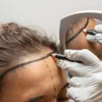 Hair Transplant