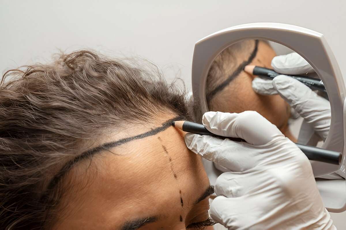 Hair Transplant