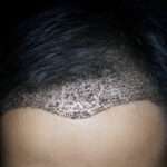 Hair Transplant