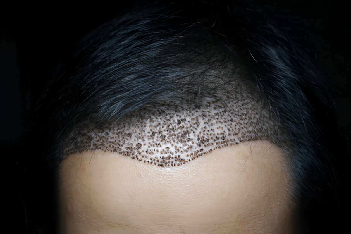 Hair Transplant