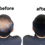 London hair transplant