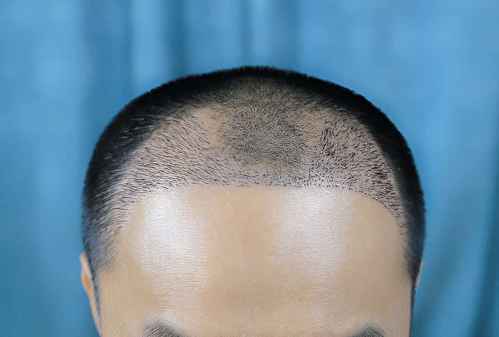 manual hair transplant London