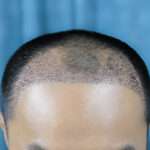 manual hair transplant London