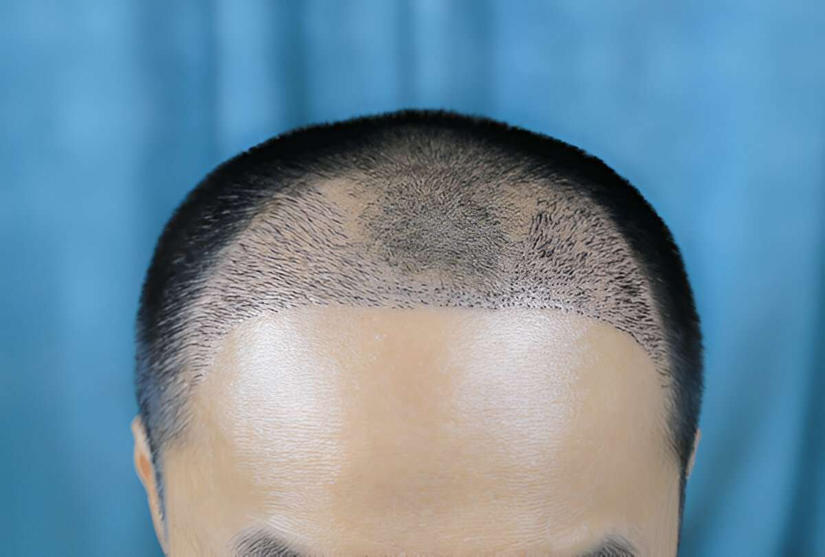 manual hair transplant London