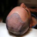 Hair Transplant