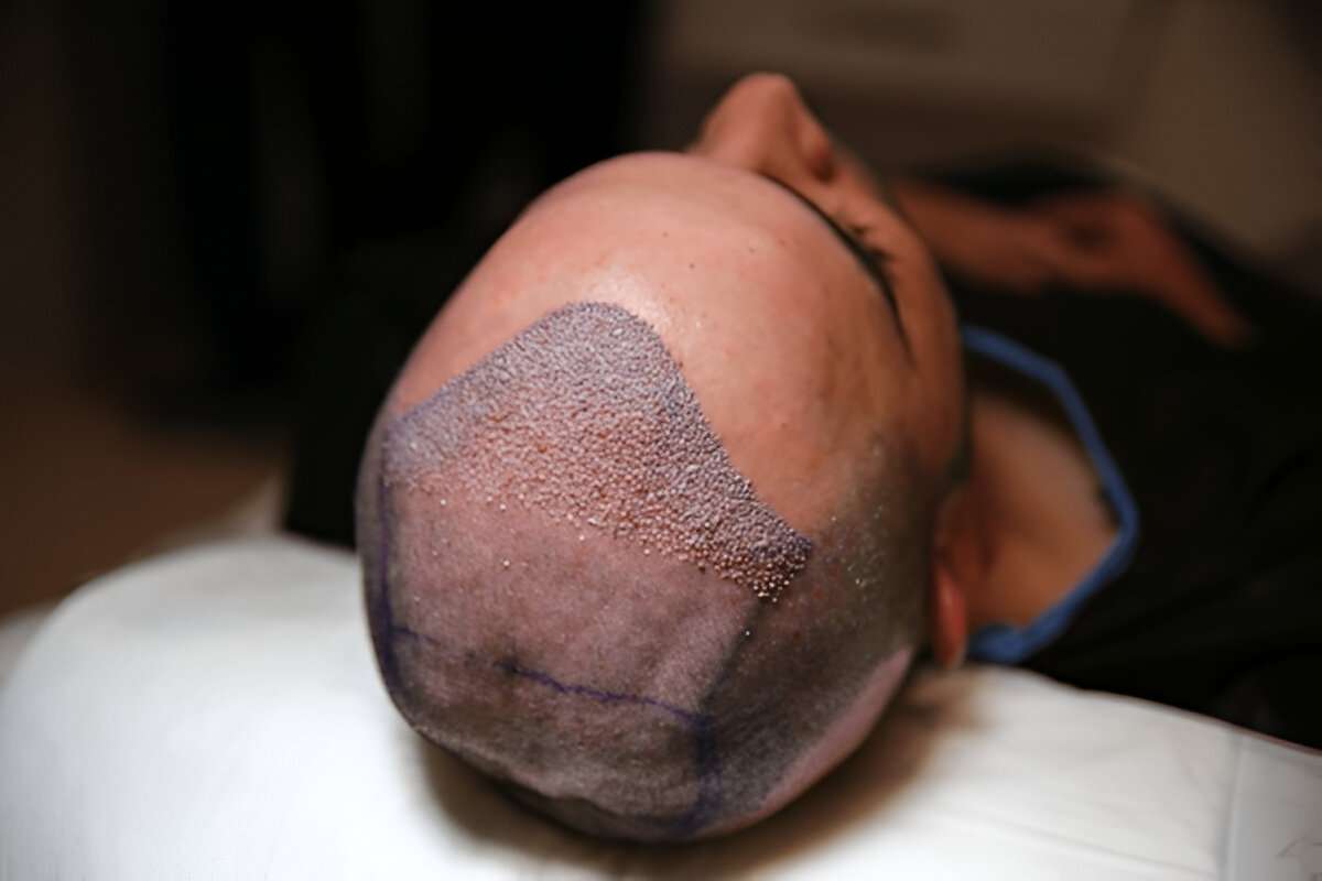 Hair Transplant
