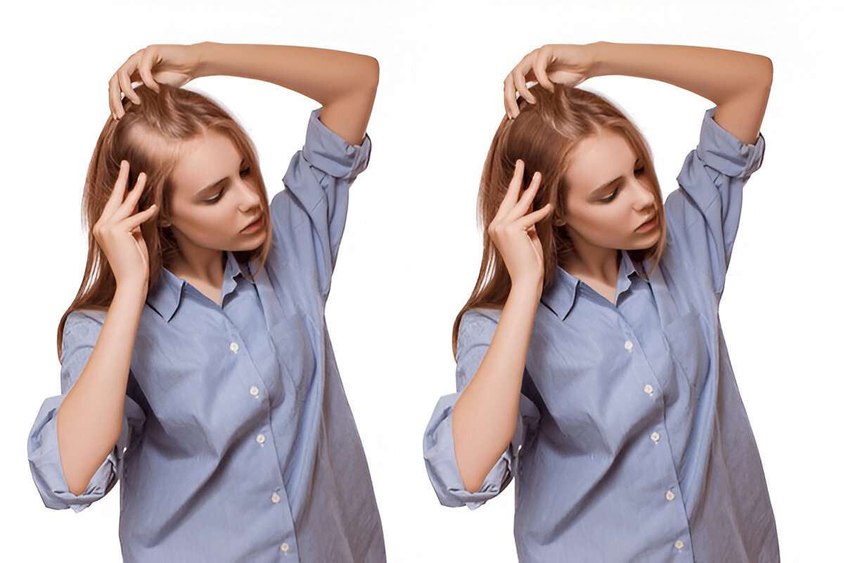 manual hair transplant