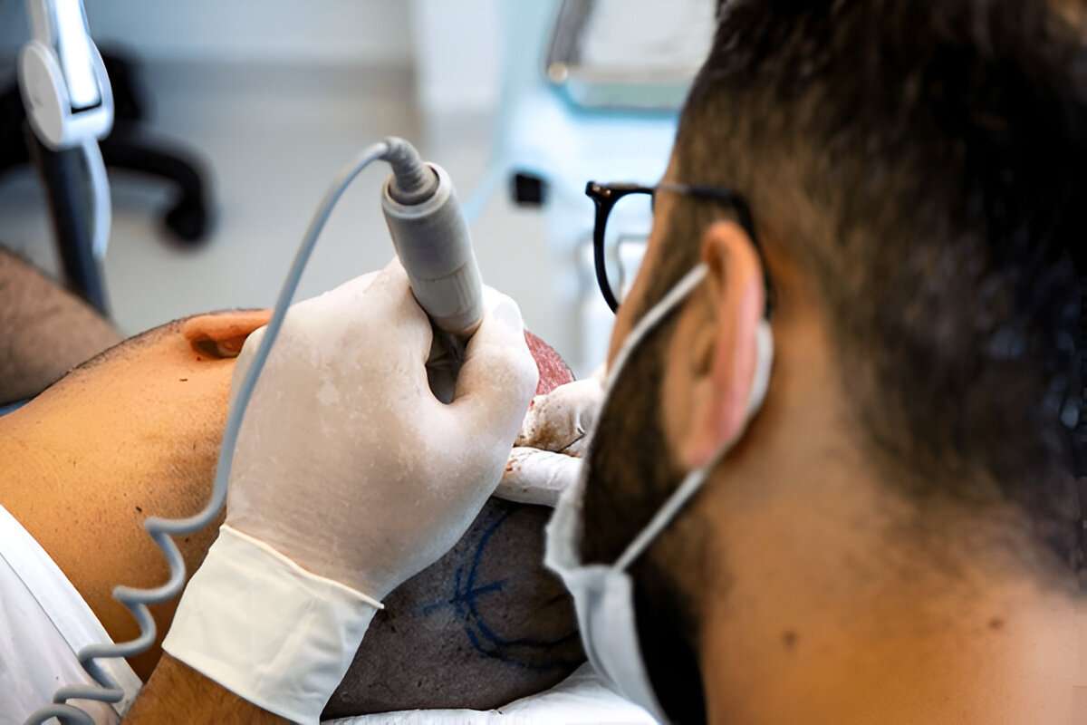 hair transplant Manchester