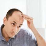 hair transplant Cardiff