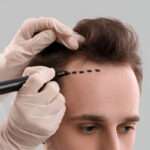 hair transplant Bristol