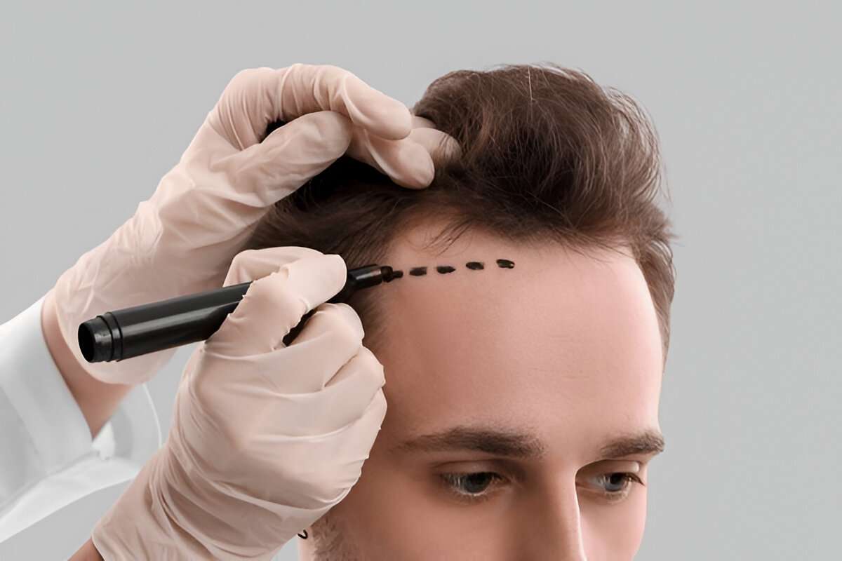 hair transplant Bristol