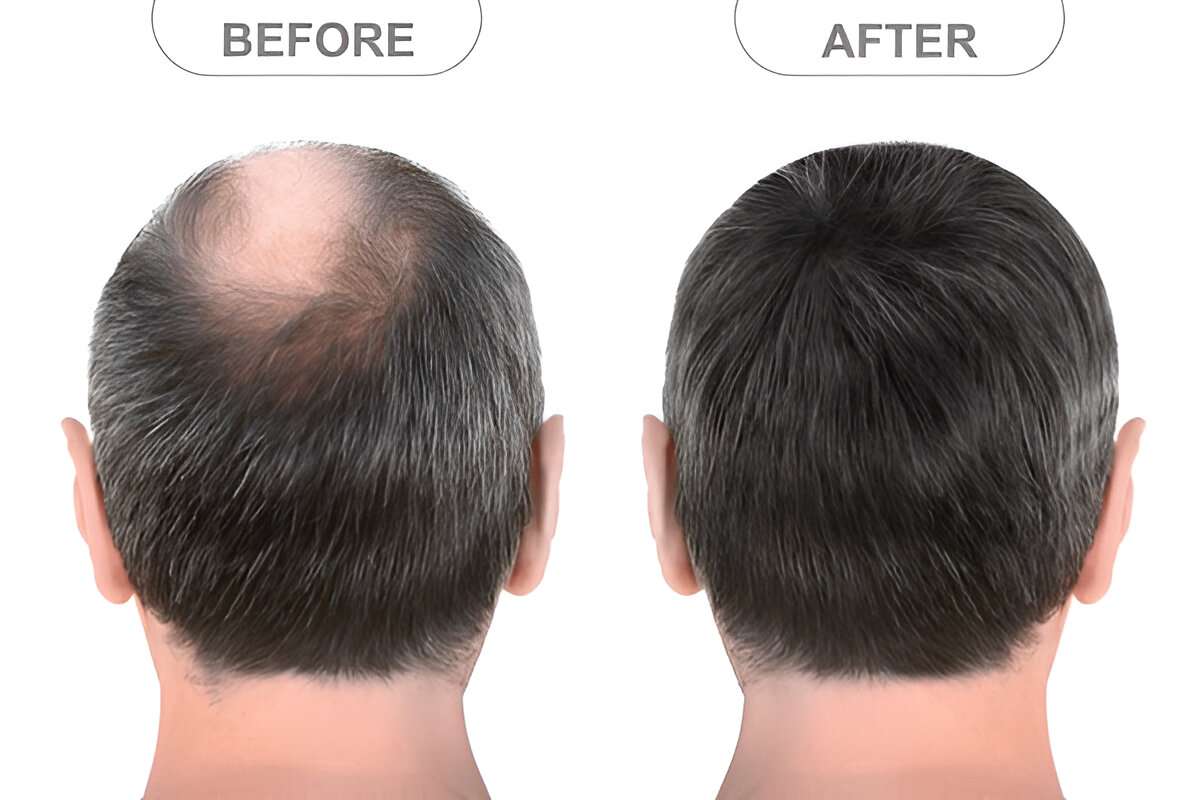 hair transplant UK