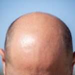 hair transplant UK