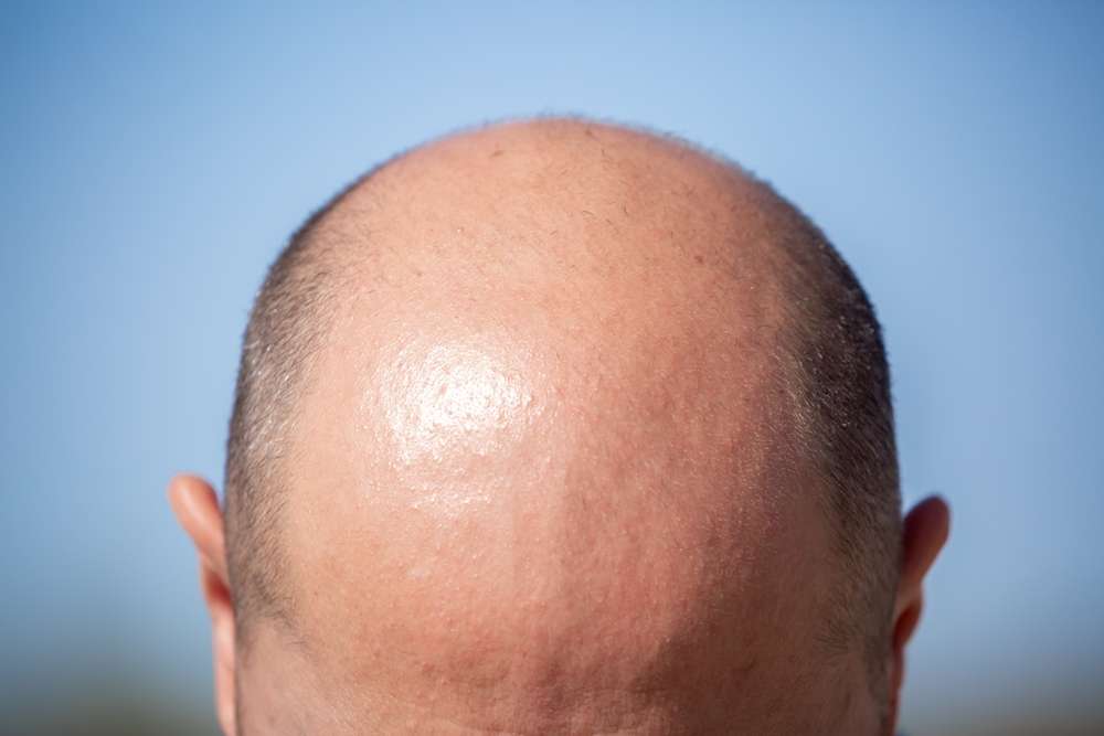 hair transplant UK