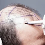Hair Transplant