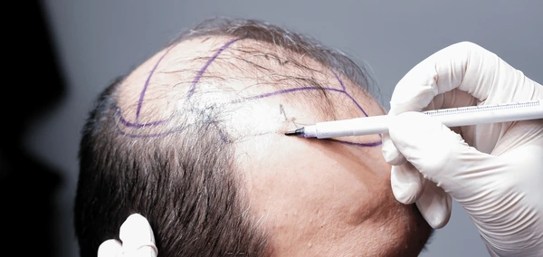 Hair Transplant