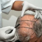 Hair Transplant