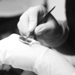 hair transplant