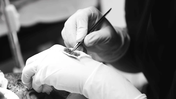hair transplant